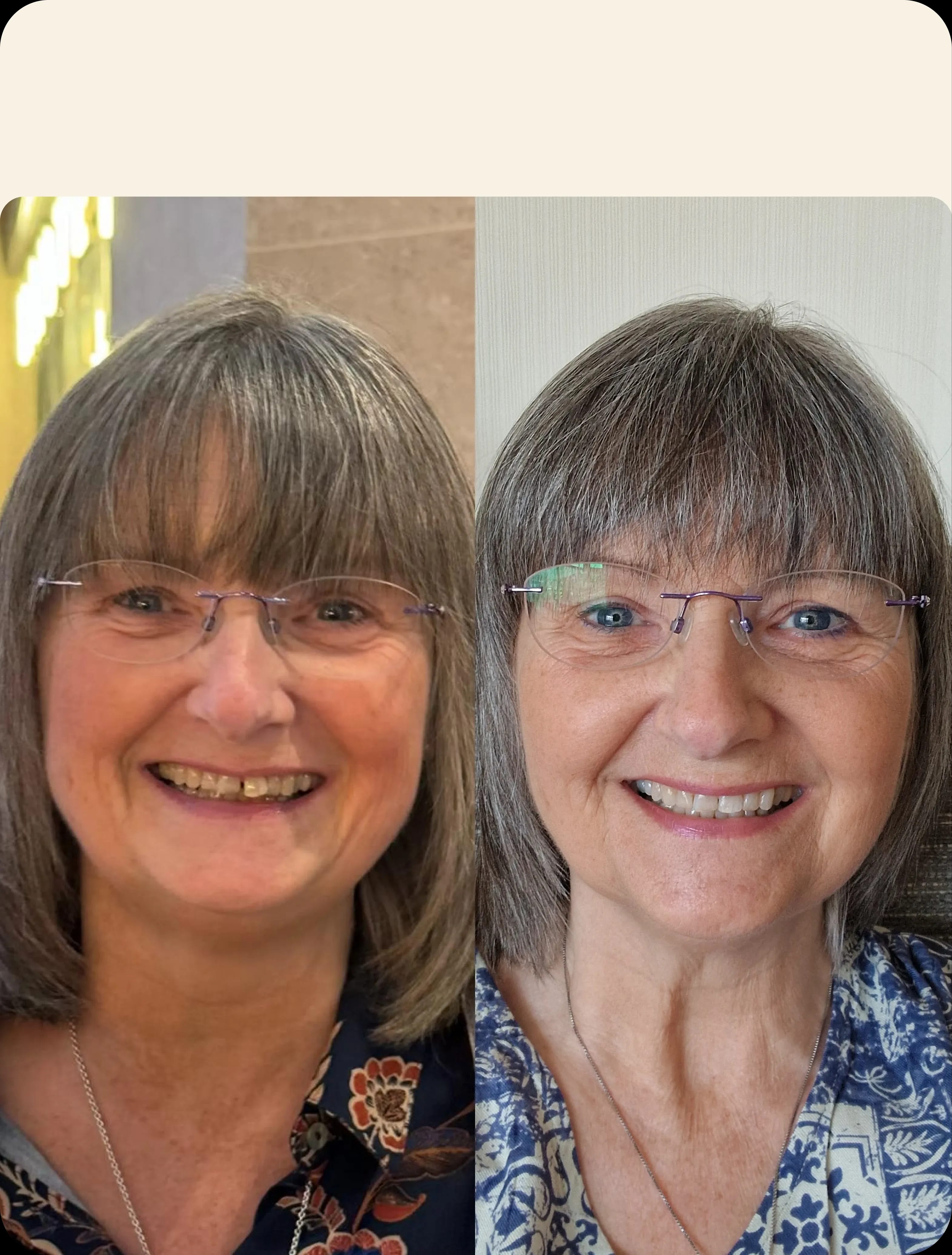 IU clear aligners before and after image portrait