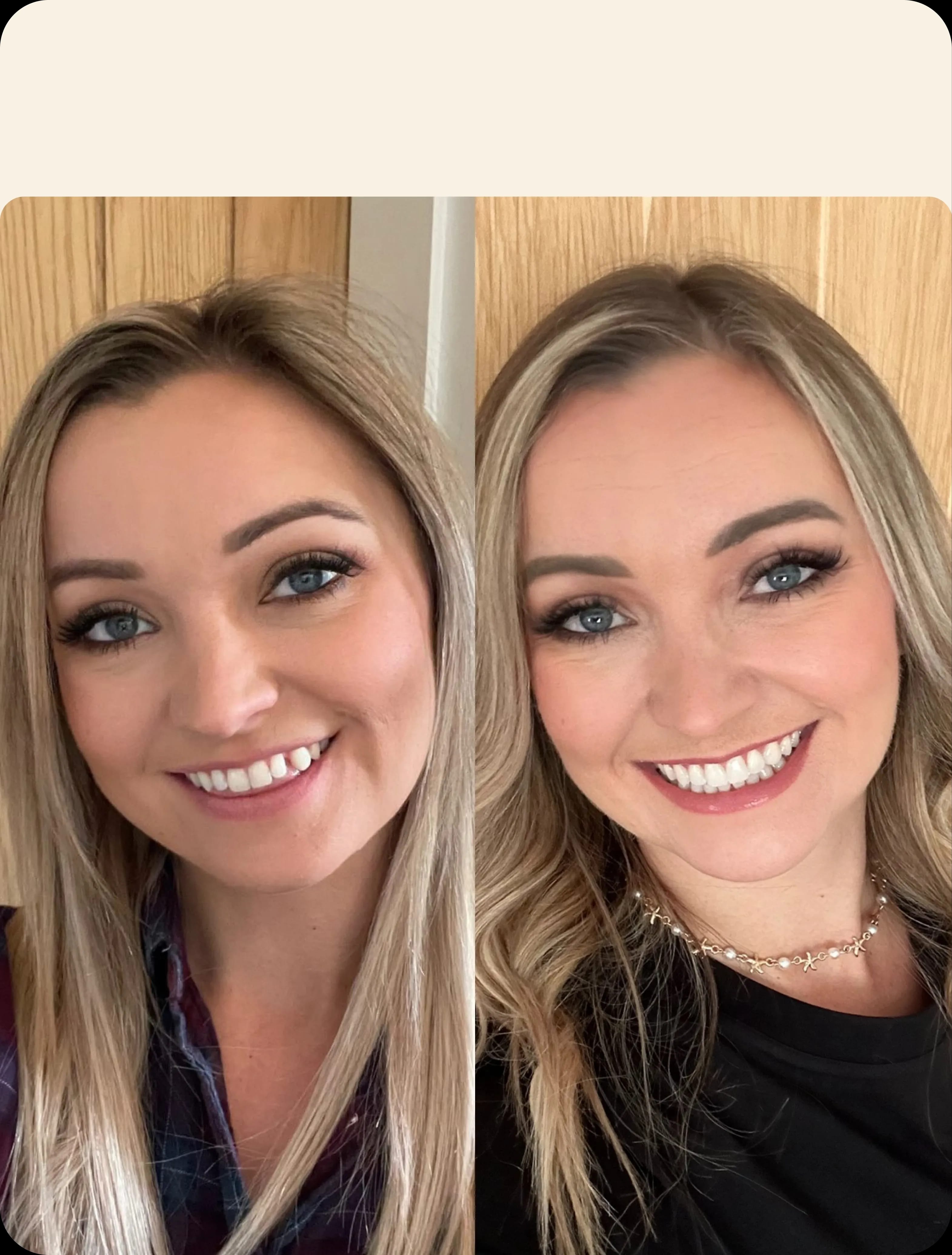 IU Clear aligners before and after image portrait