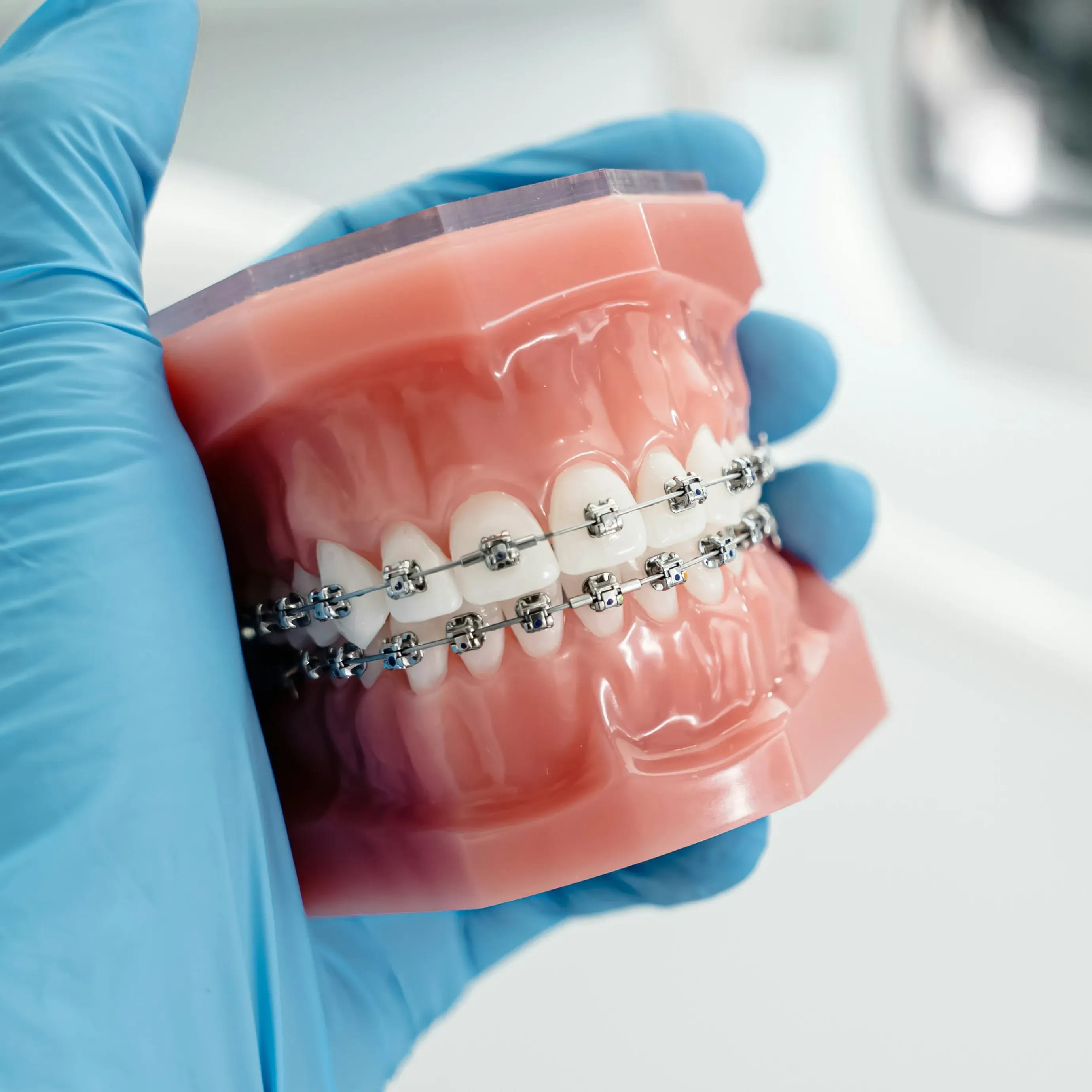 IU fixed metal braces