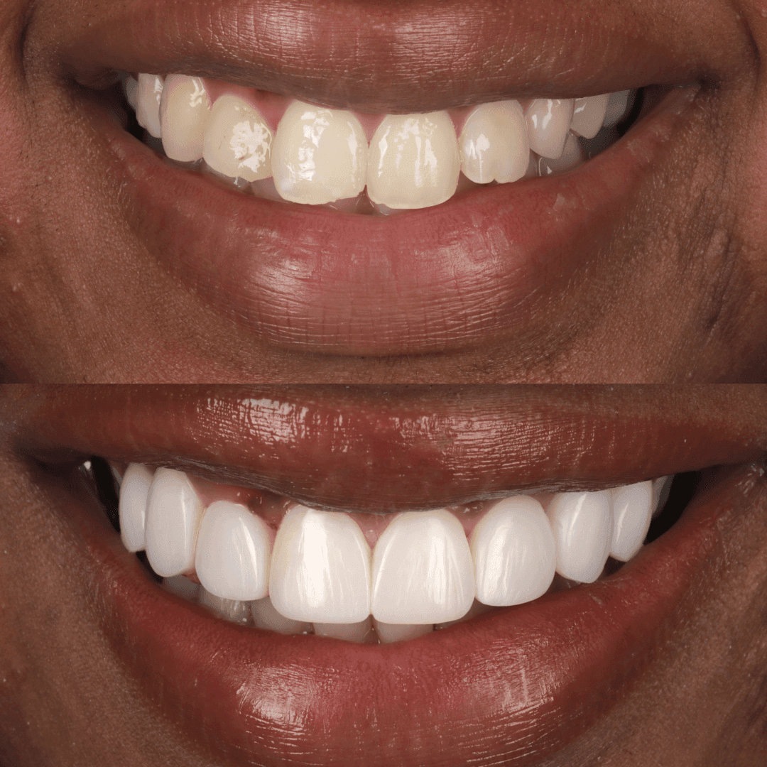 Composite Bonding Yorkshire Dental Suite
