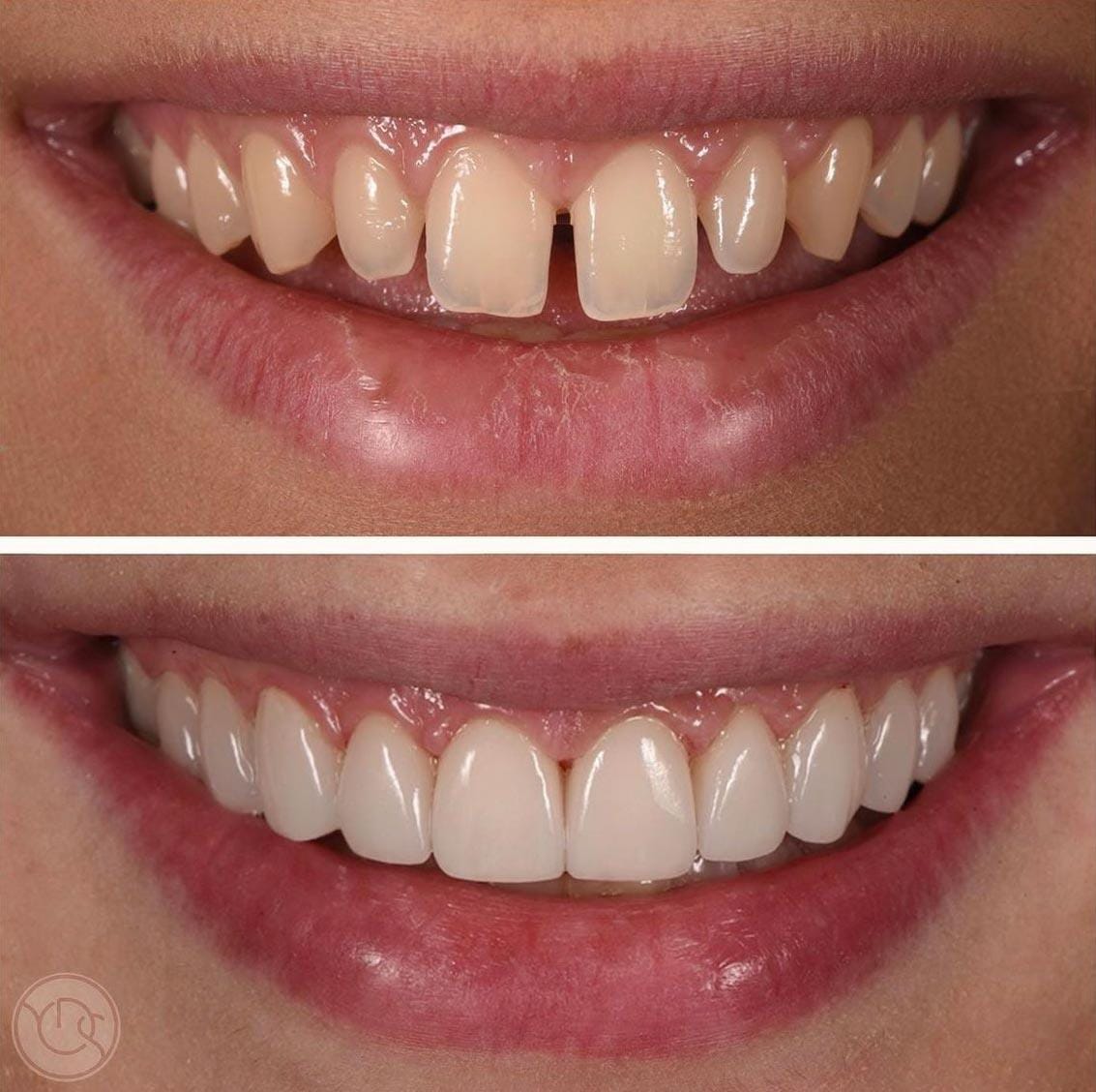 teeth veneers before and after