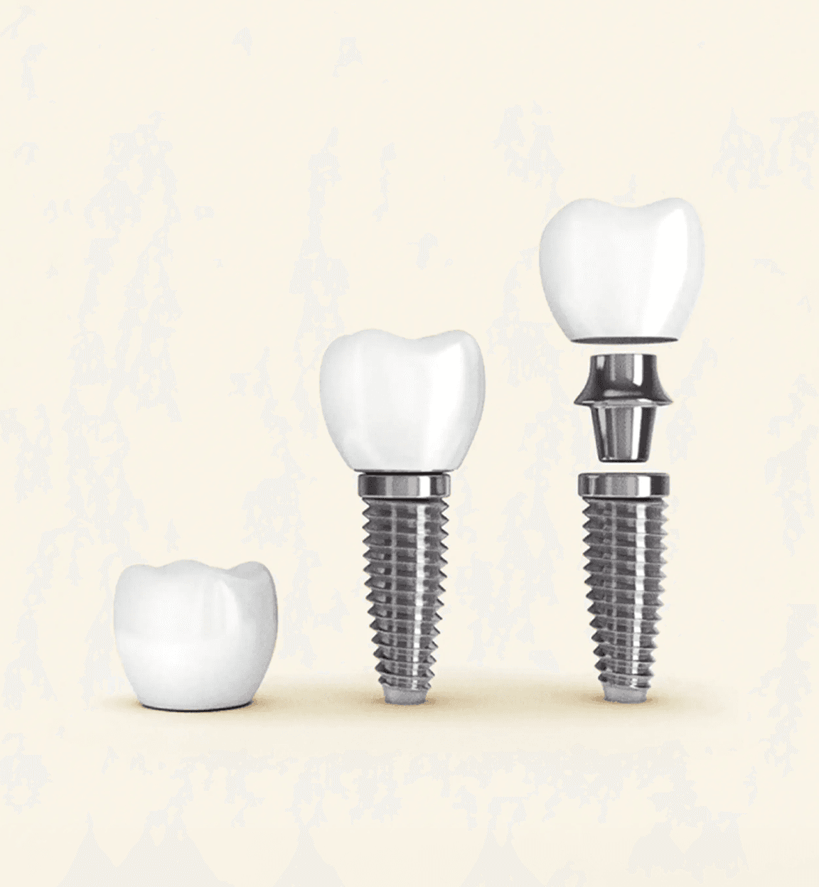 Implants_Single