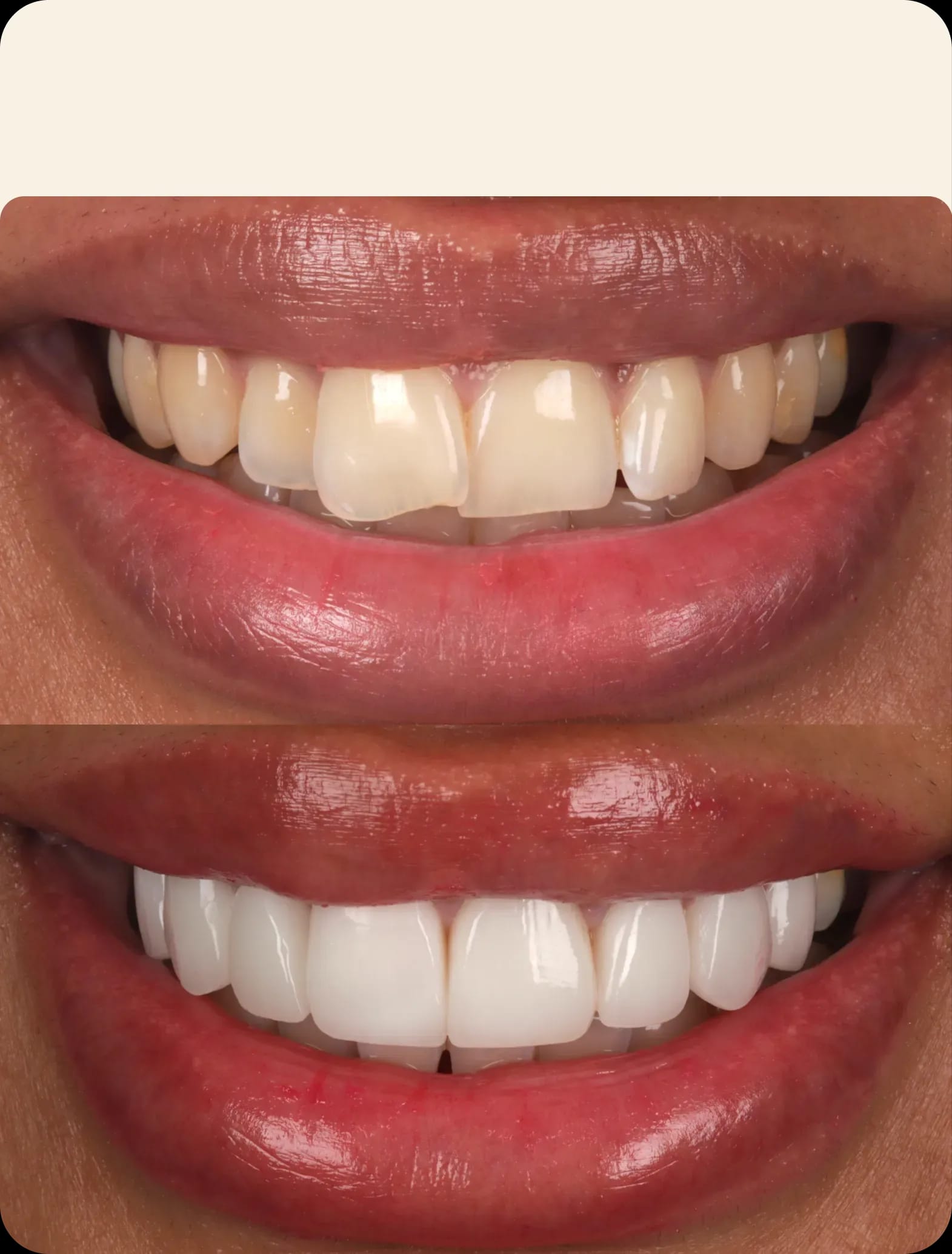 Porcelain veneers before and after pictures