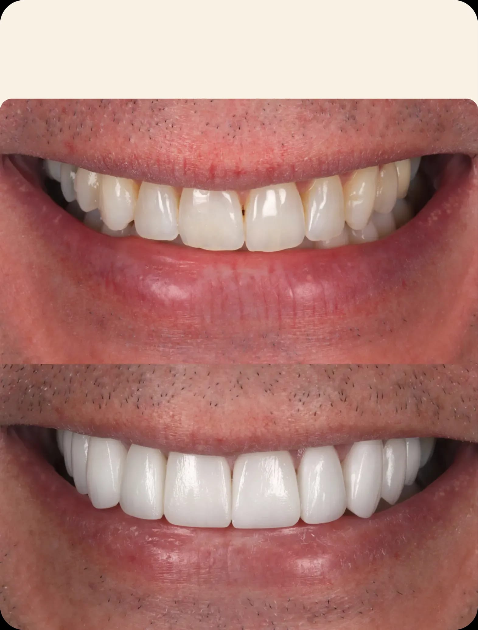Porcelain veneers before and after pictures