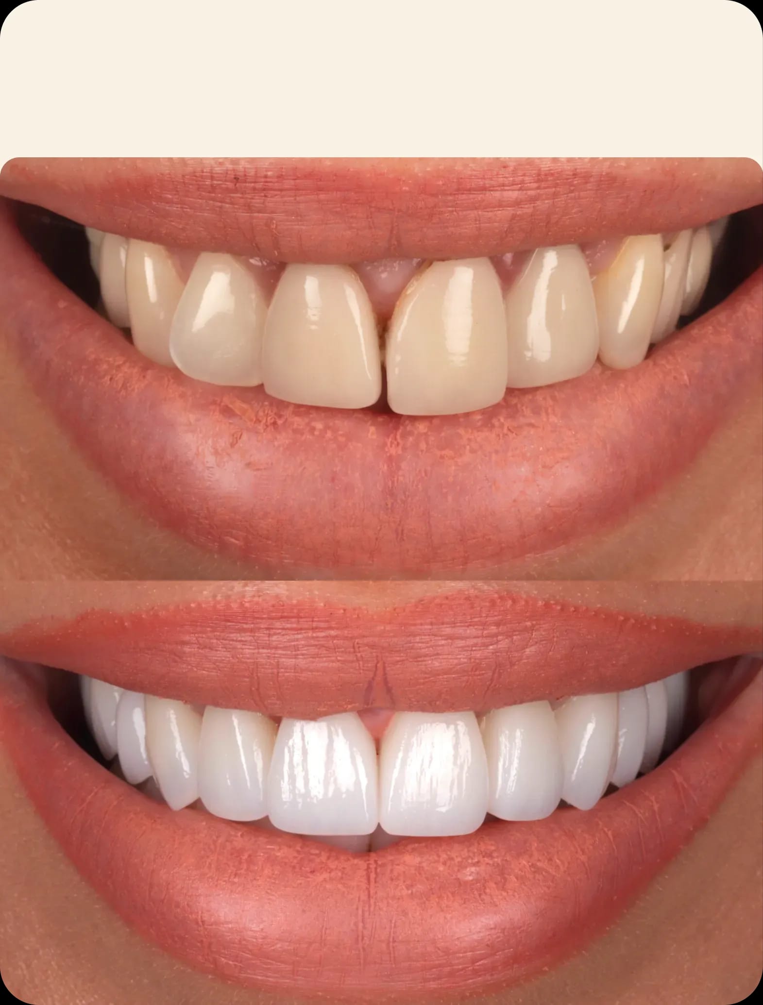 Porcelain veneers before and after pictures