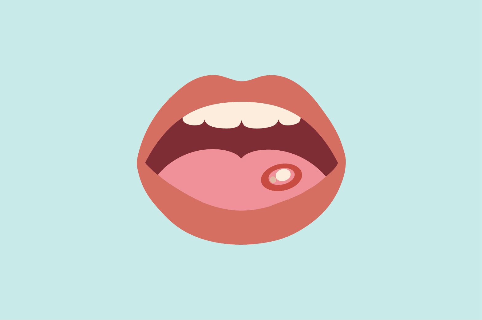 IU ulcer