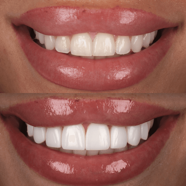 Before and After Composite Bonding Teeth | Composite Veneers ...