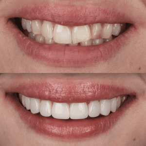 IU composite bonding before and after