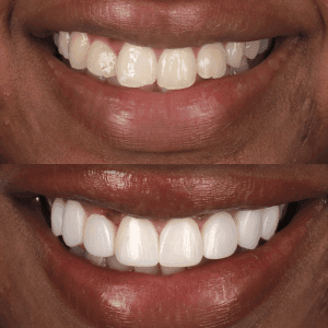 IU composite bonding before and after