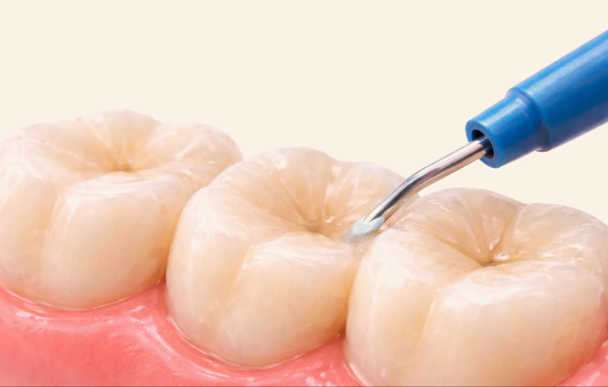 IU composite fillings