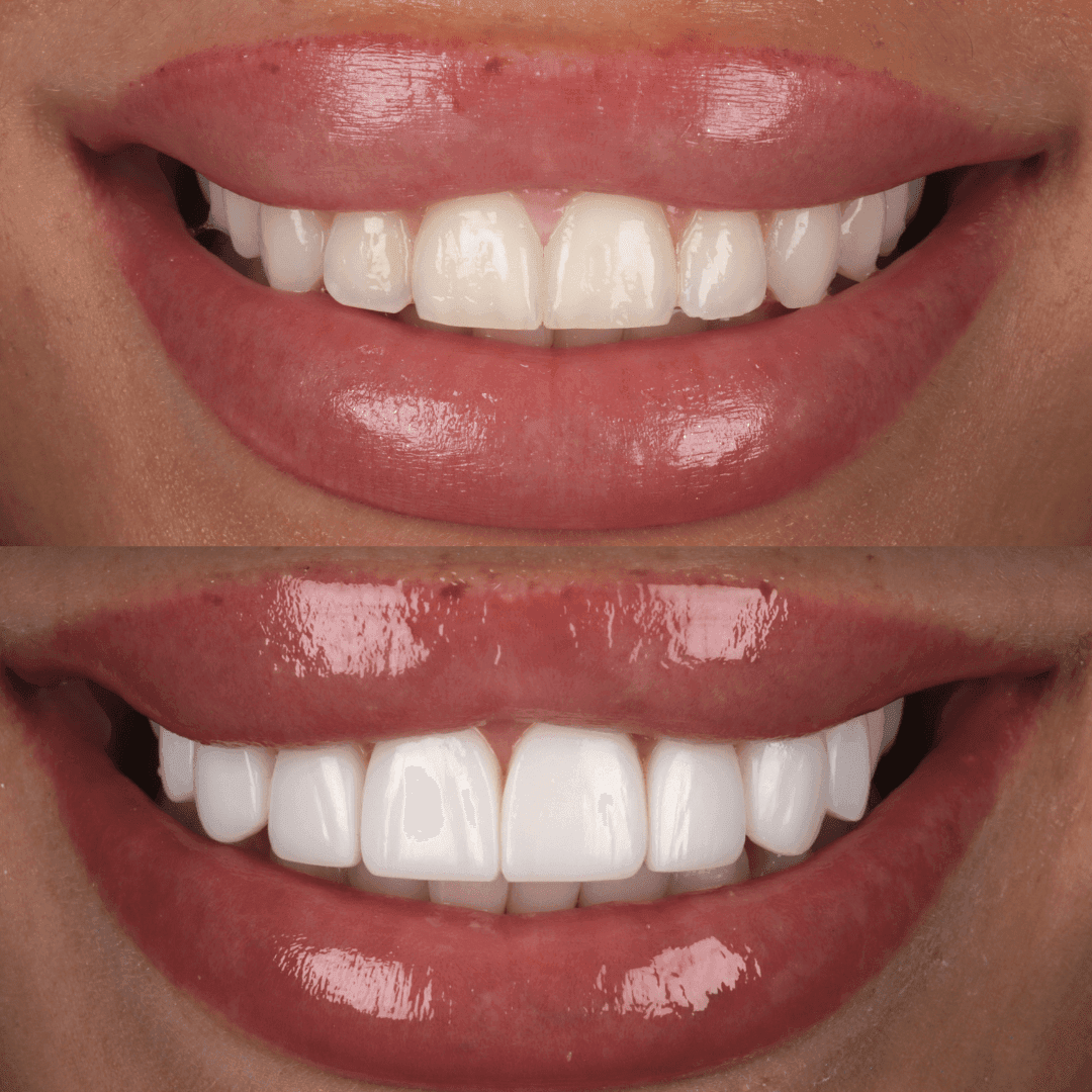 IU composite veneers before and after