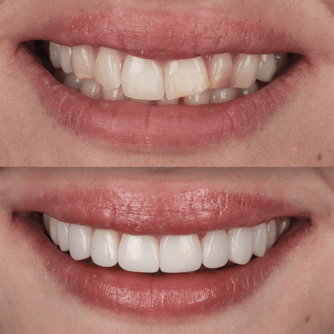 IU composite veneers before and after