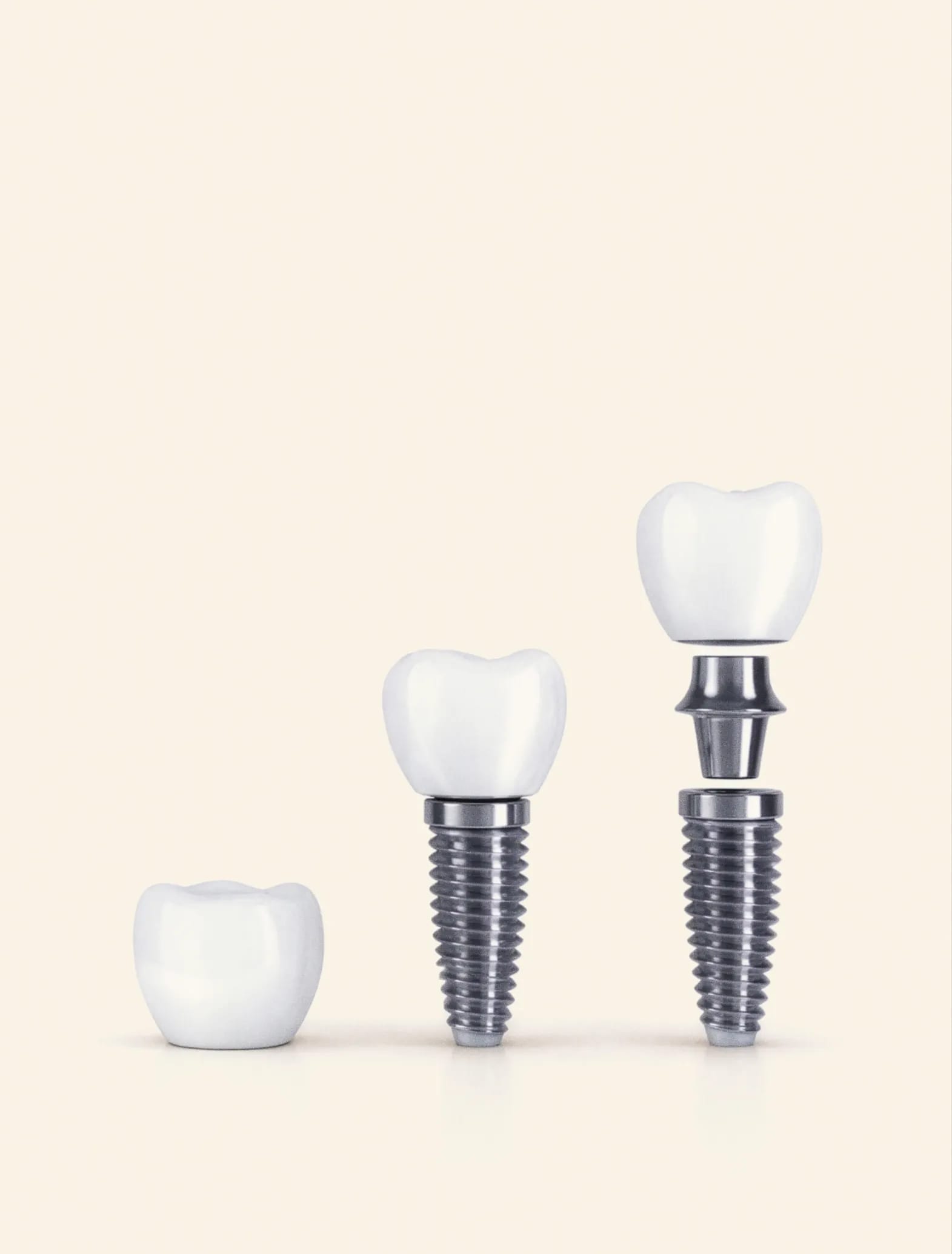 IU single tooth dental implant