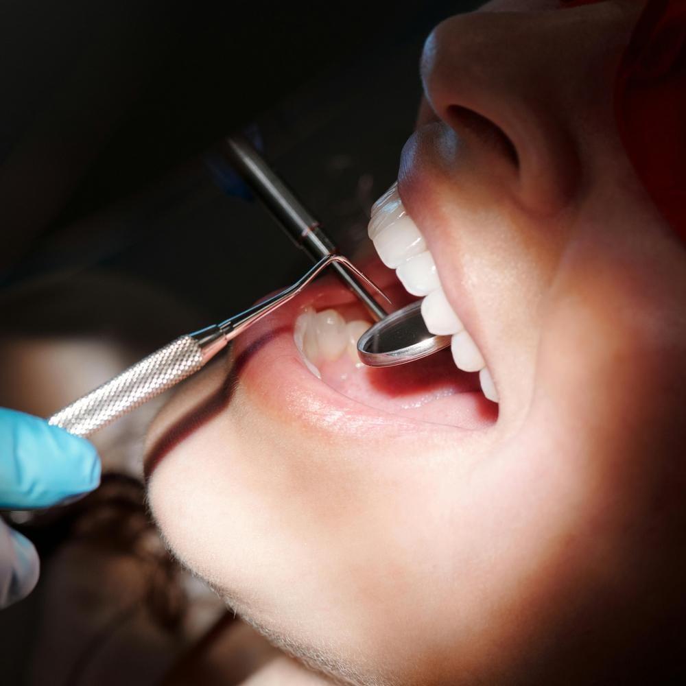 IU dental cavities and tooth decay