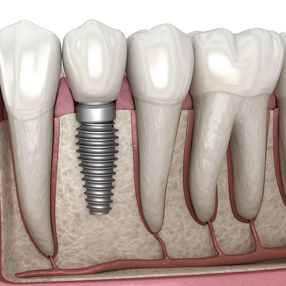 IU dental implant vs crowns