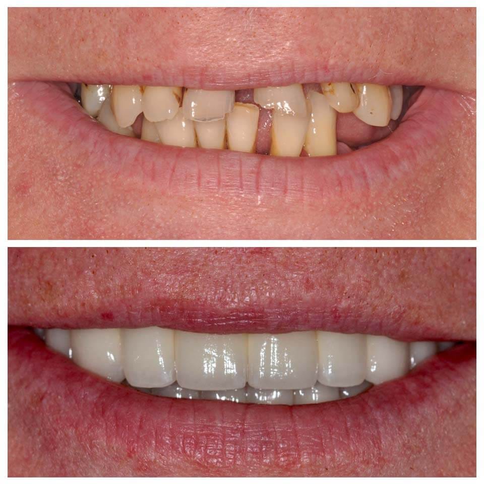 IU dental implants before and after pics