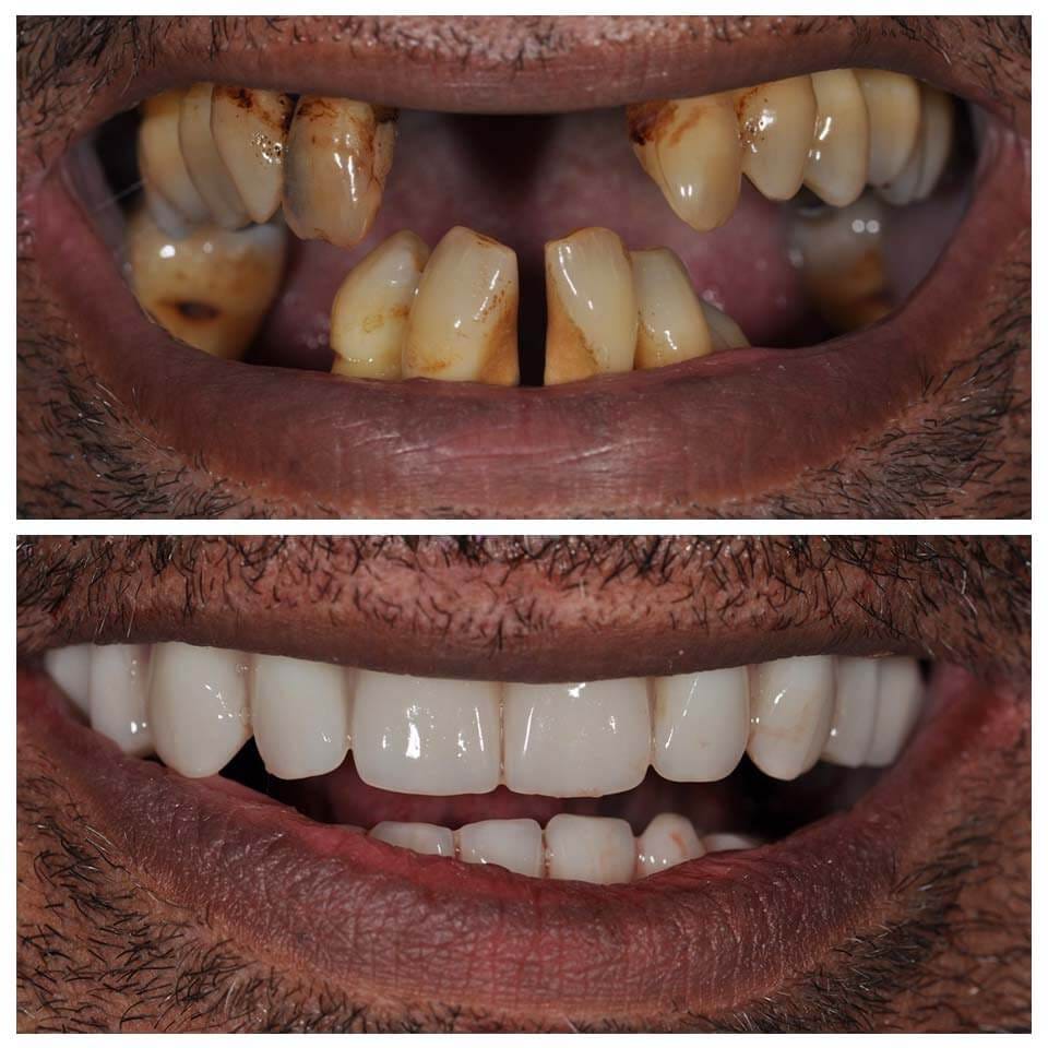 IU dental implants before and after pics