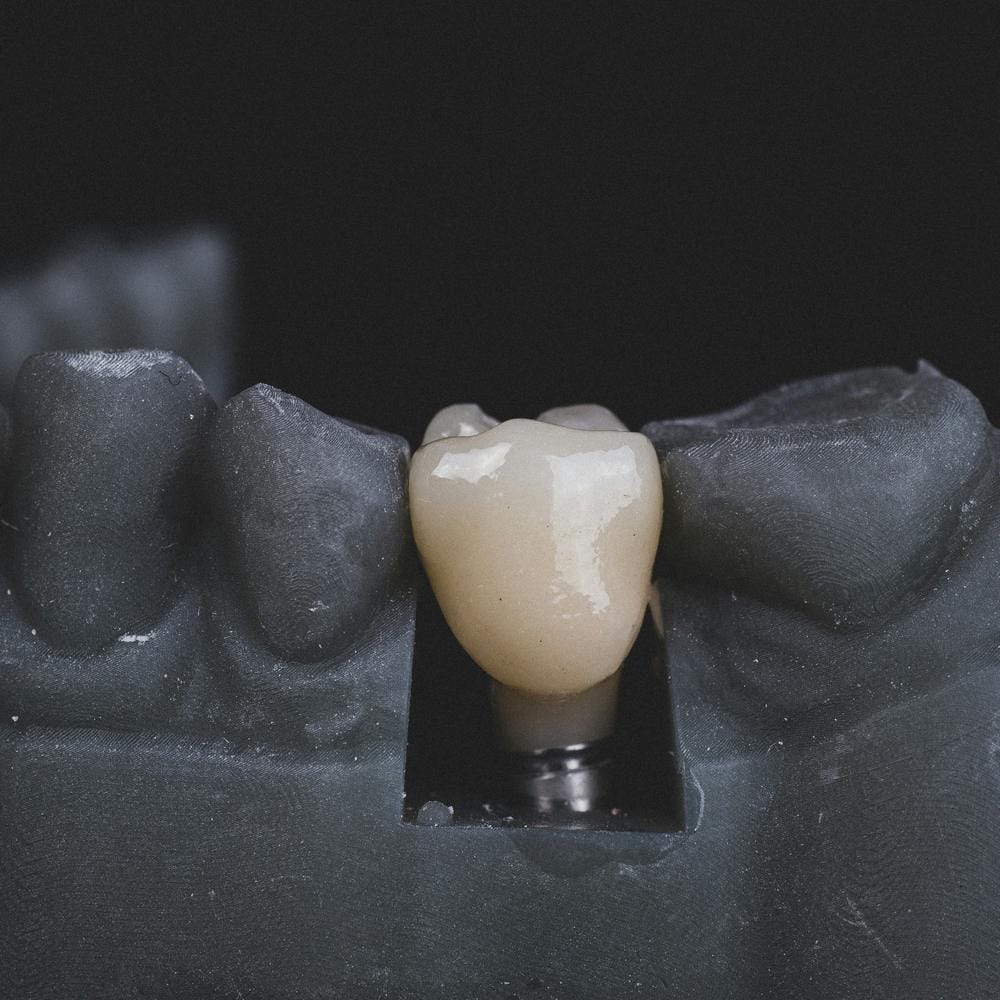 IU do I need molar teeth implants