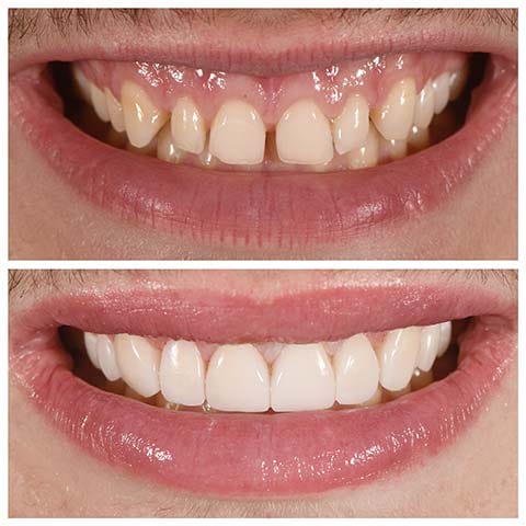 porcelain veneers before and after