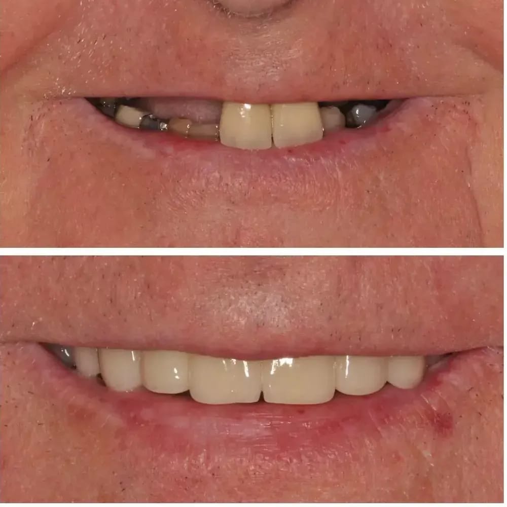 missing-teeth-options