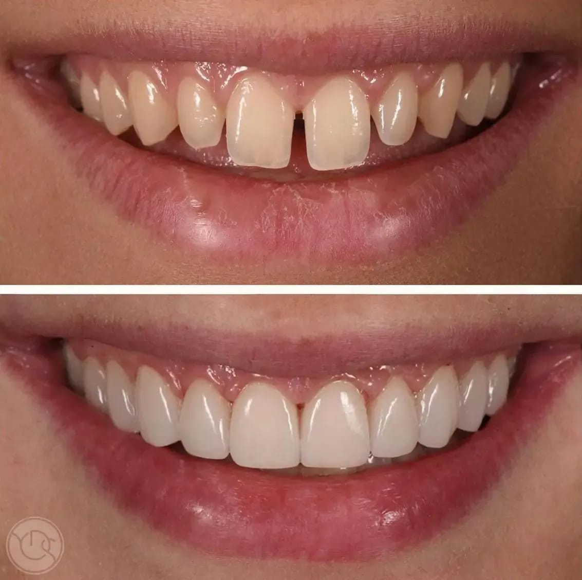 Porcelain veneers before and after photos