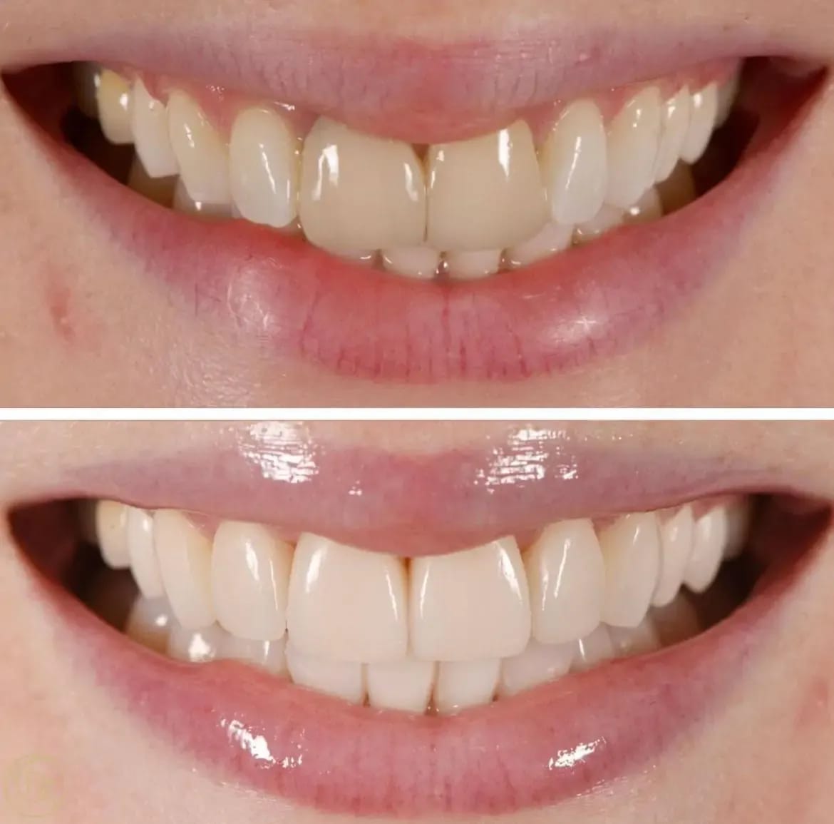 Porcelain veneers before and after pictures