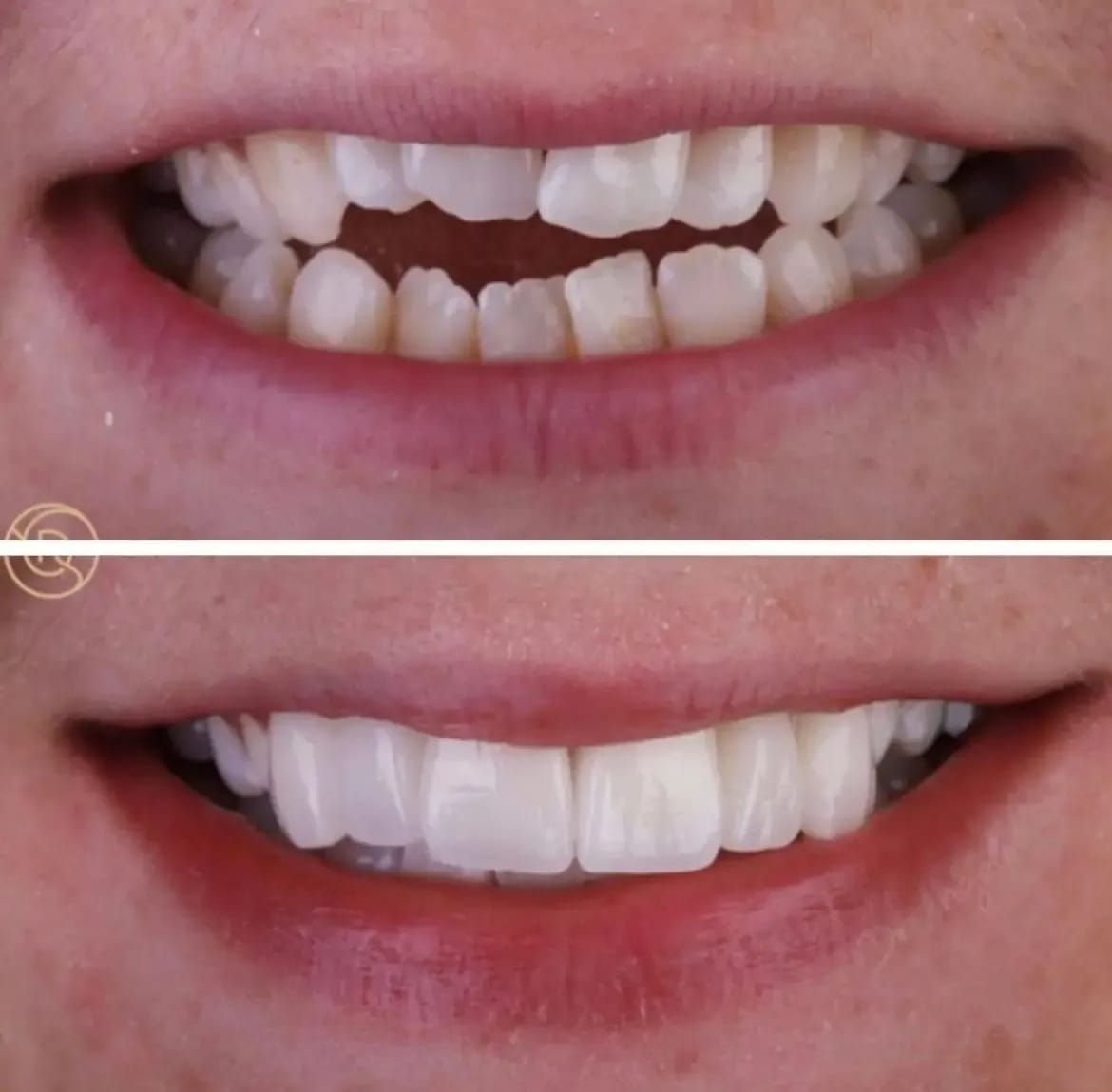 Porcelain veneers before and after