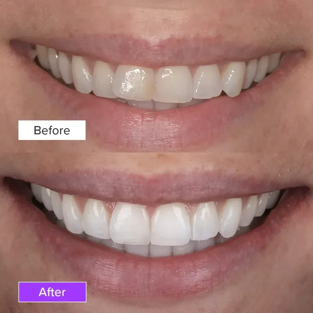 teeth-whitening-before-and-after-1