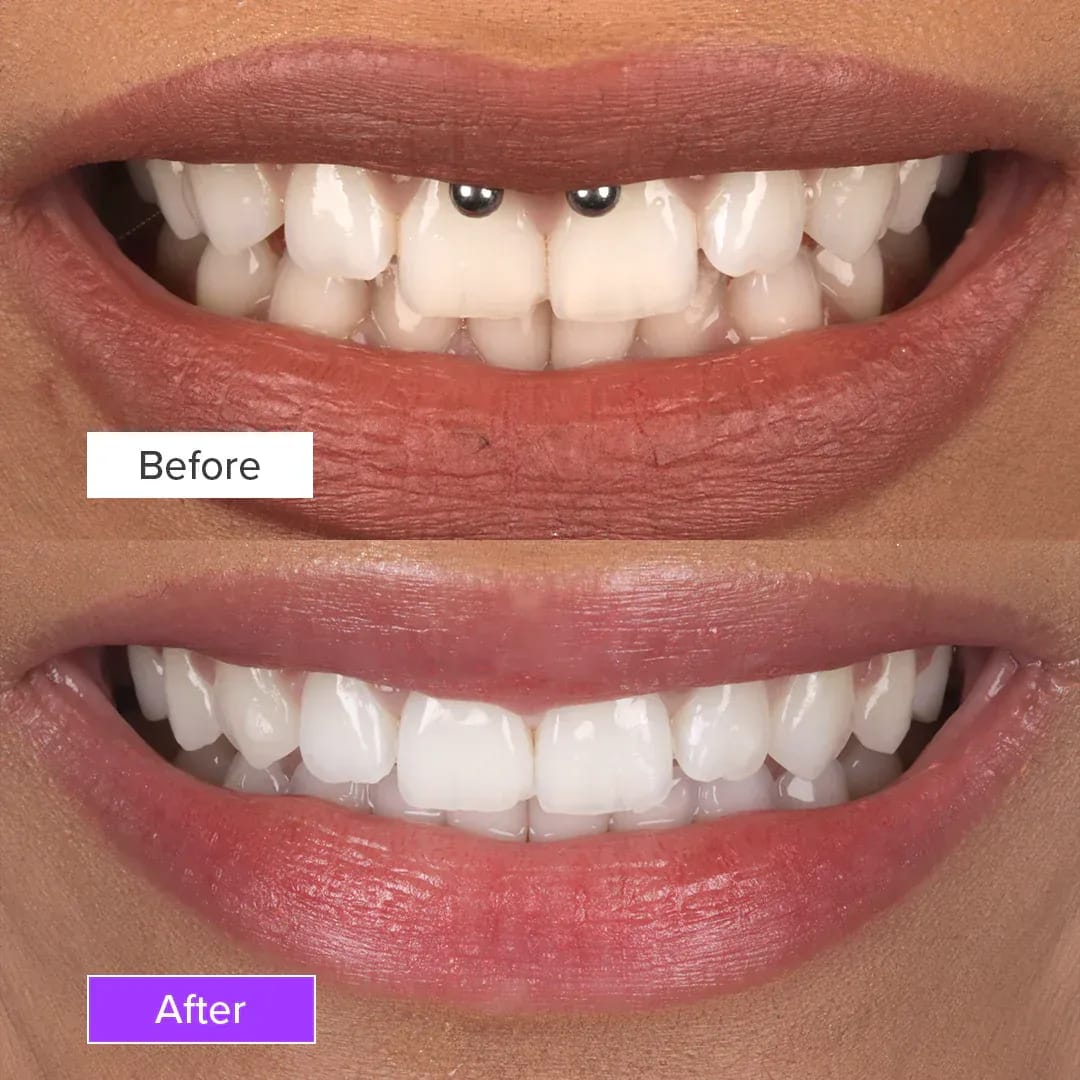 teeth-whitening-before-and-after-2