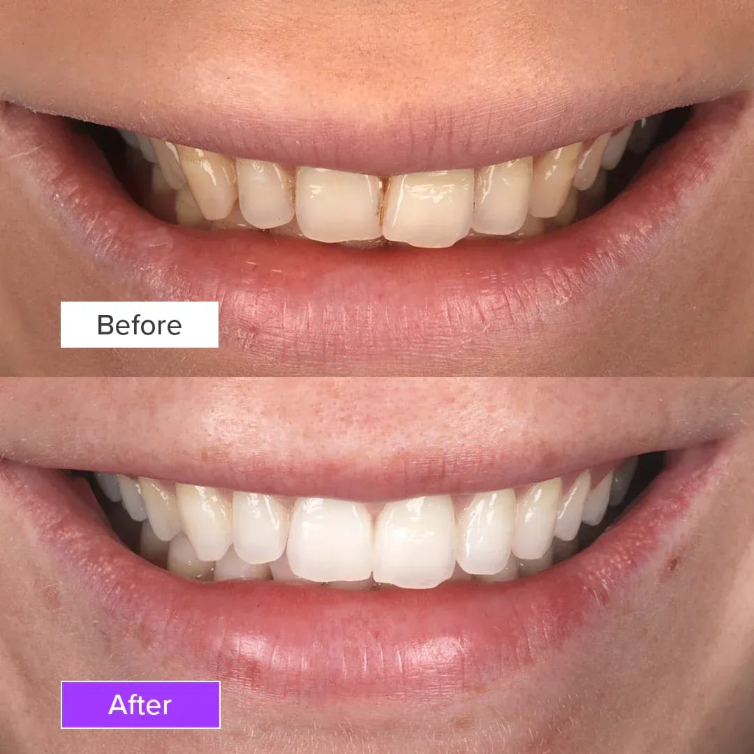 teeth-whitening-before-and-after-3