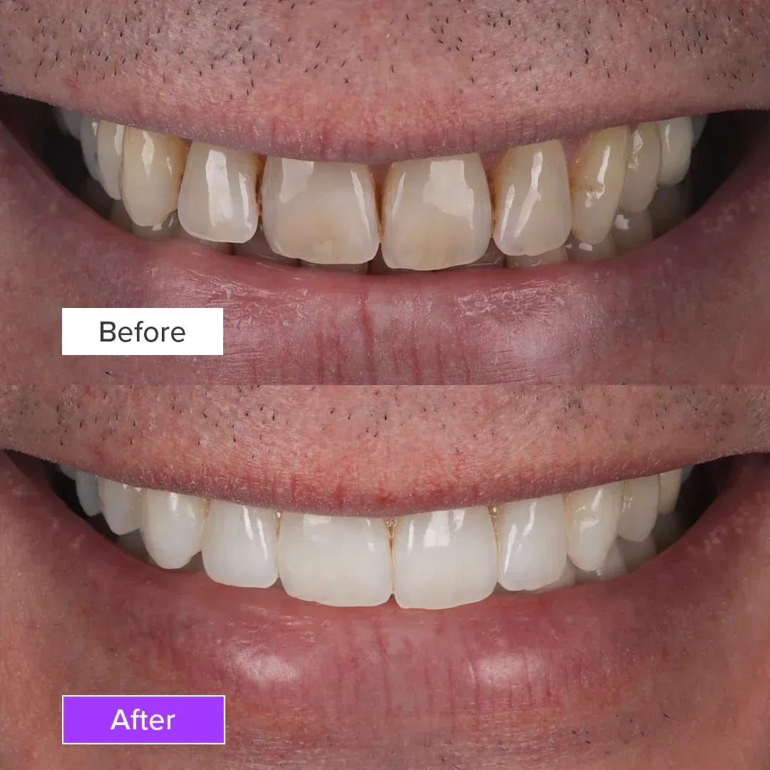 teeth-whitening-before-and-after-3