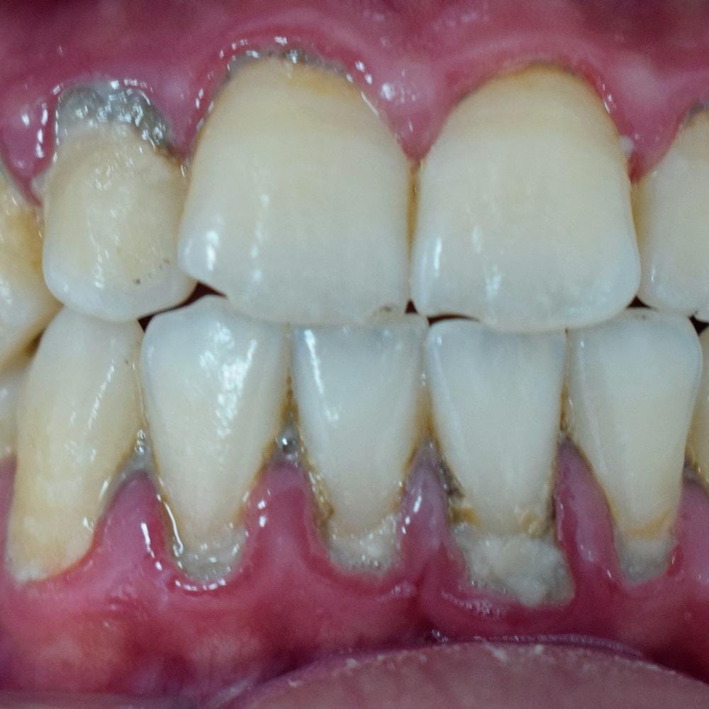 tooth-decalcification