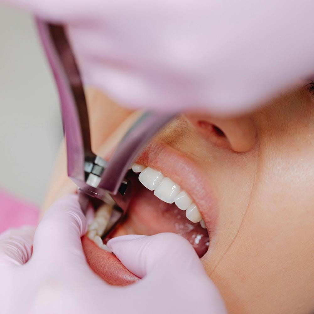 tooth-extraction
