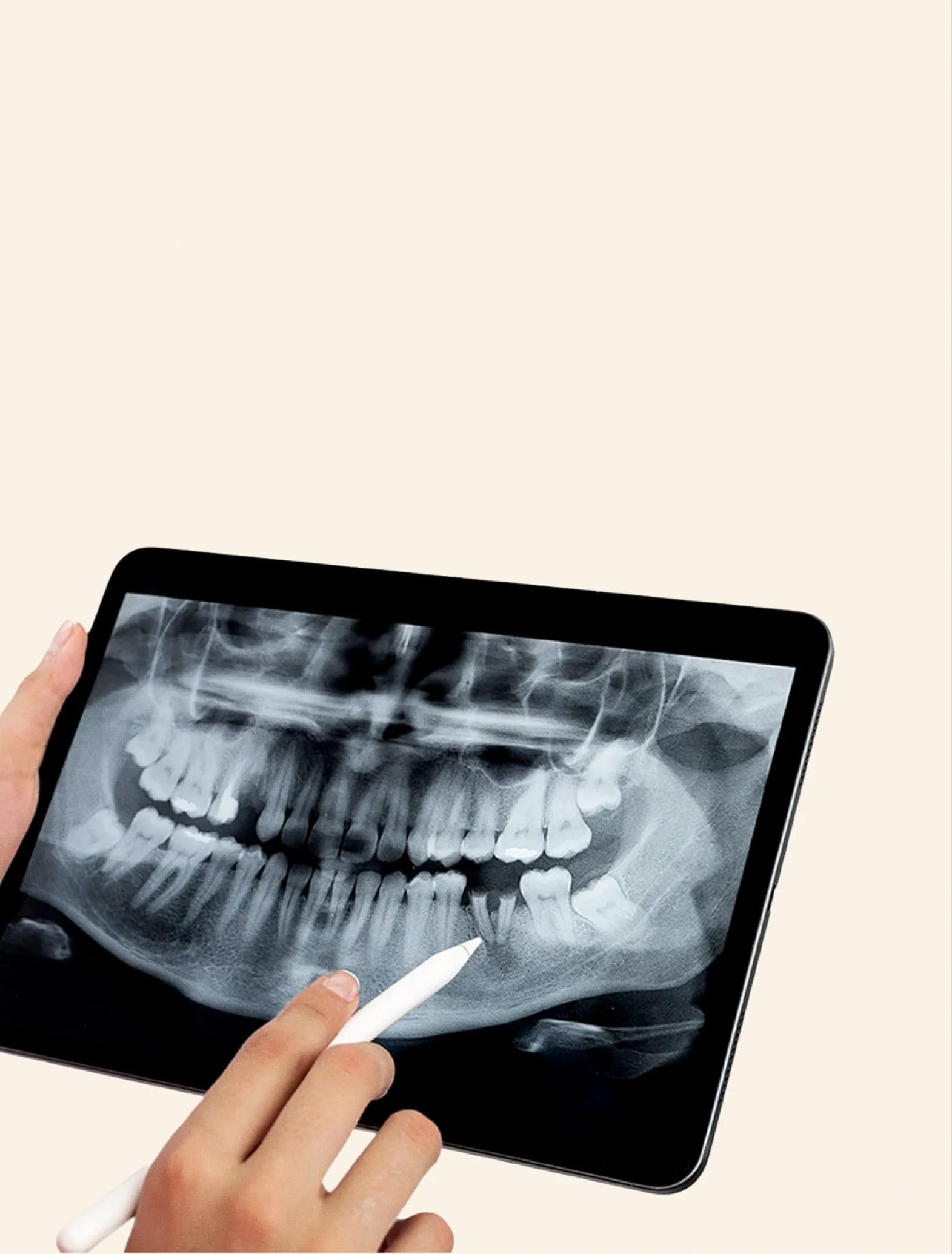 Wisdom tooth removal