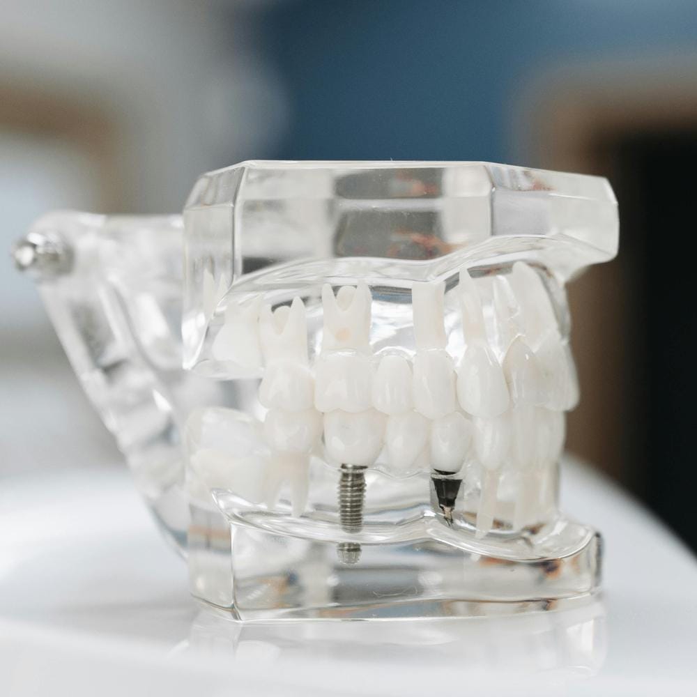 IU 4 on 4 dental implants