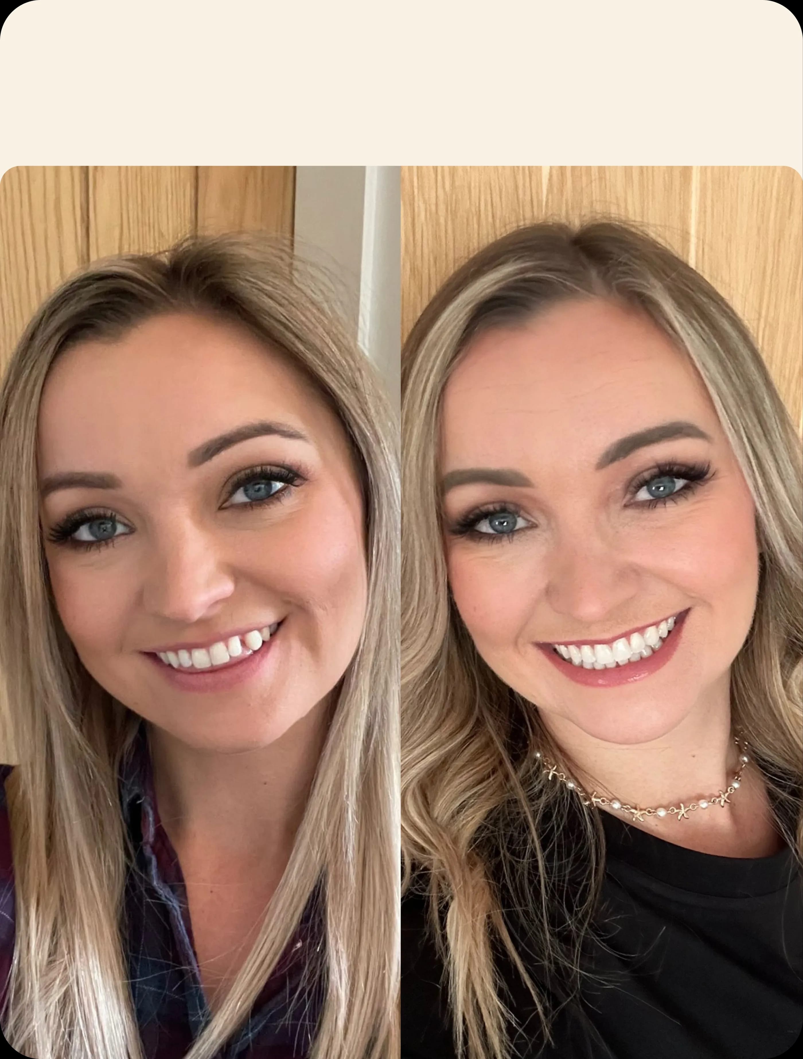 IU Clear aligners before and after image portrait