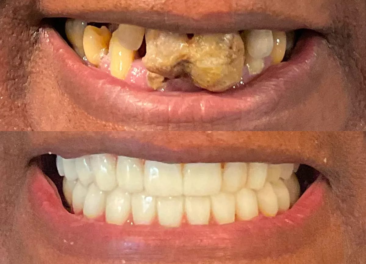 Dentasl implants before and after