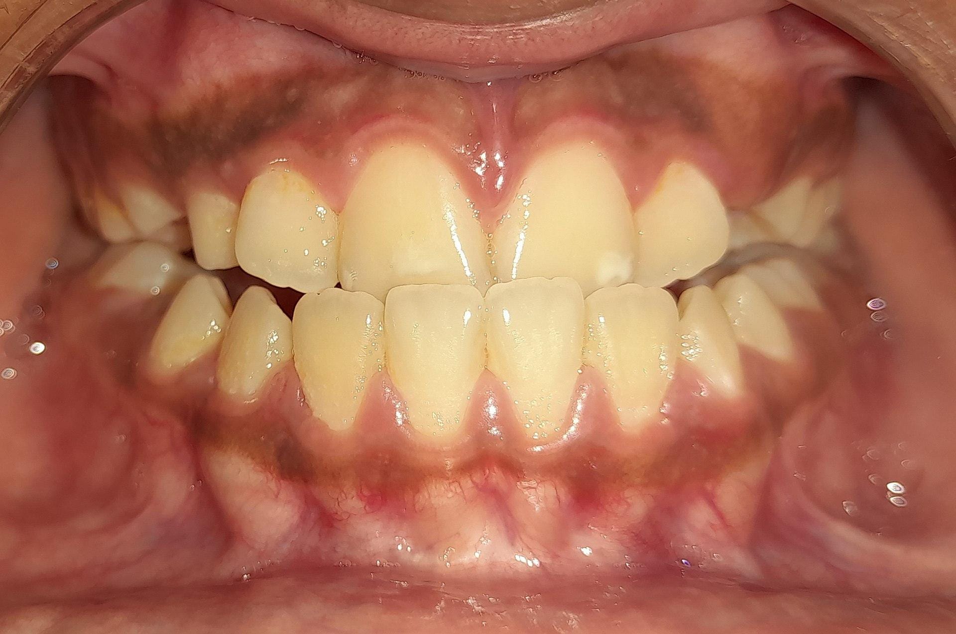 IU crossbite