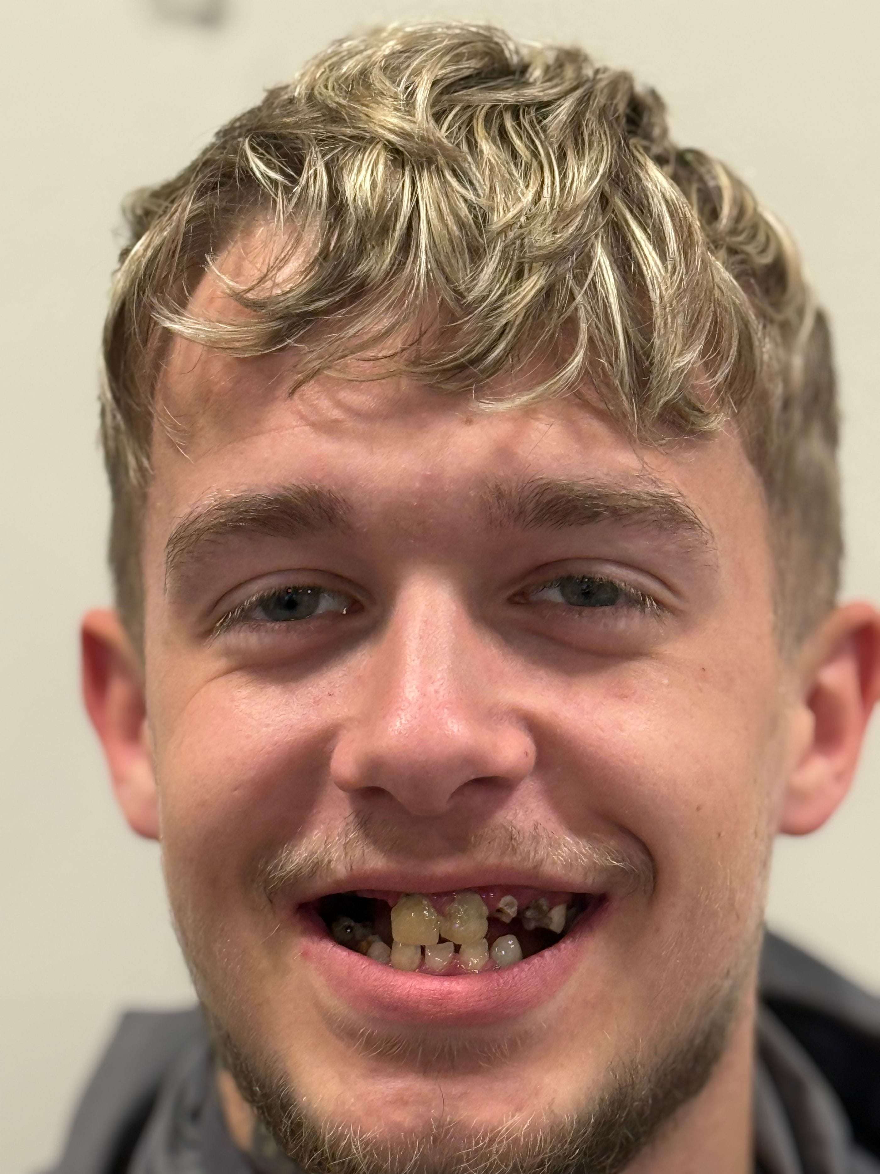 reagan-turkey-teeth-transformation