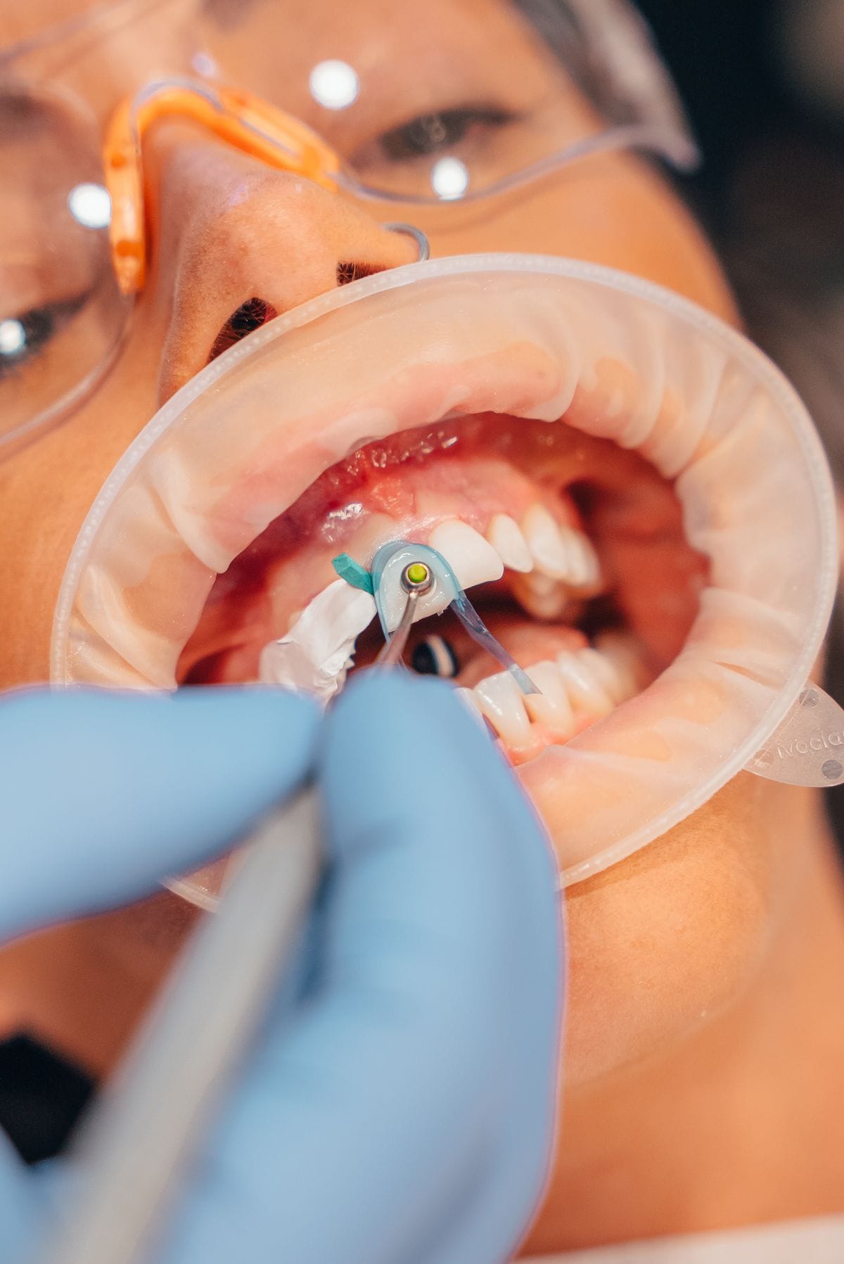Nanofill Composite Bonding - Patient Mouth