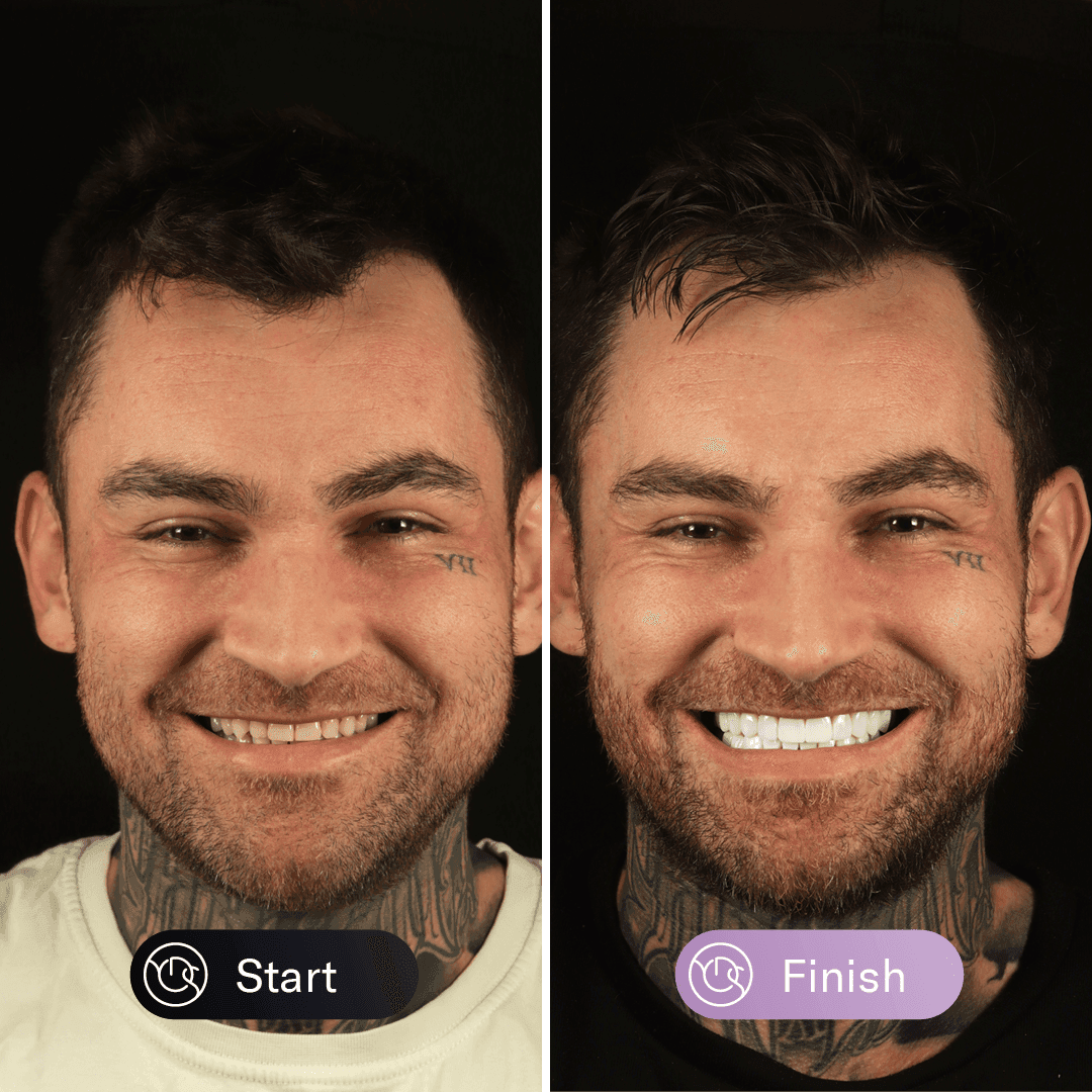 Nanofill Composite Bonding Before & After (Male)