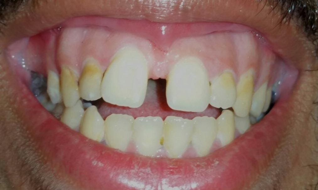 Open-Bite