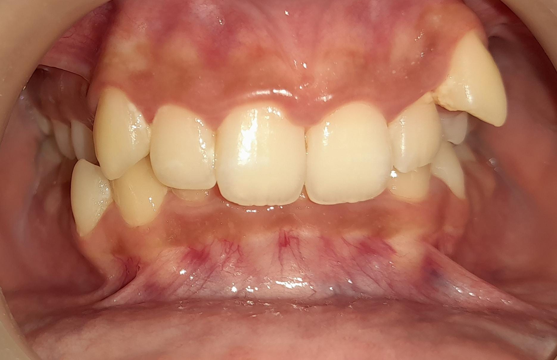 Overbite