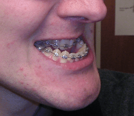 Underbite
