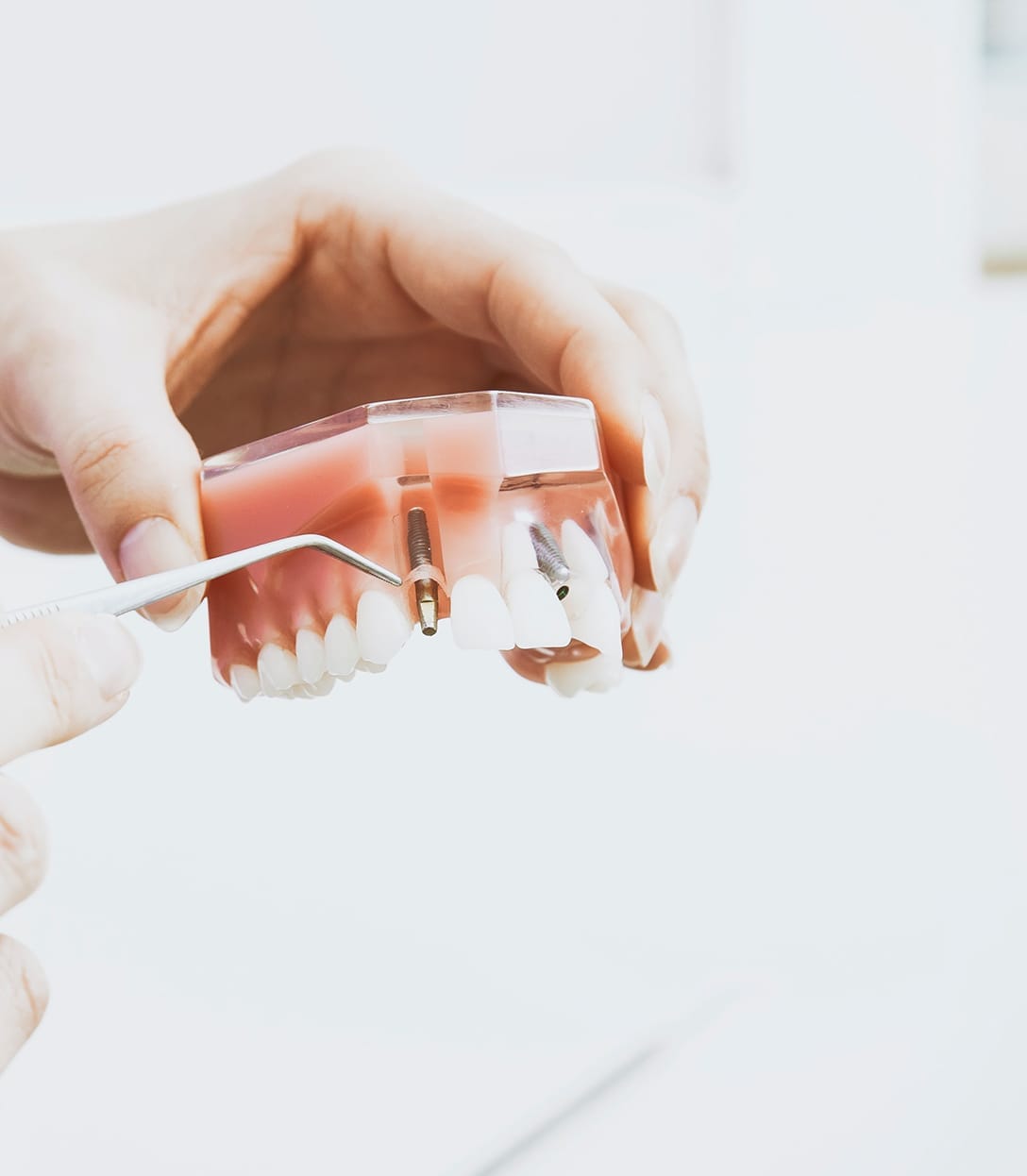 Yorkshire_Dental_Suite_Blog_Dental_Implants-1