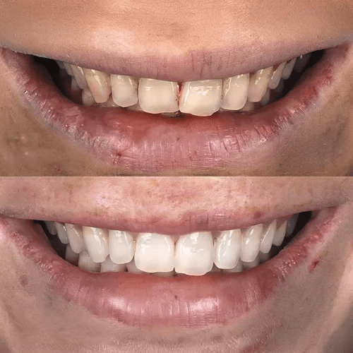clear aligners and whitening before and after pictures