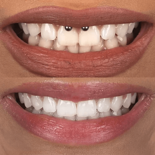 clear aligners and whitening before and after pictures