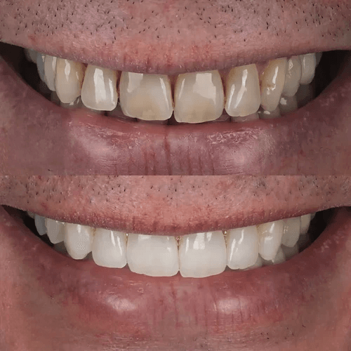 clear aligners and whitening before and after pictures