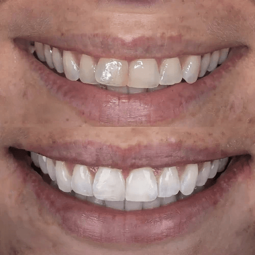 clear aligners and whitening before and after pictures