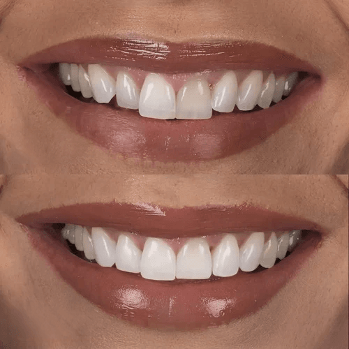 clear aligners and whitening before and after pictures